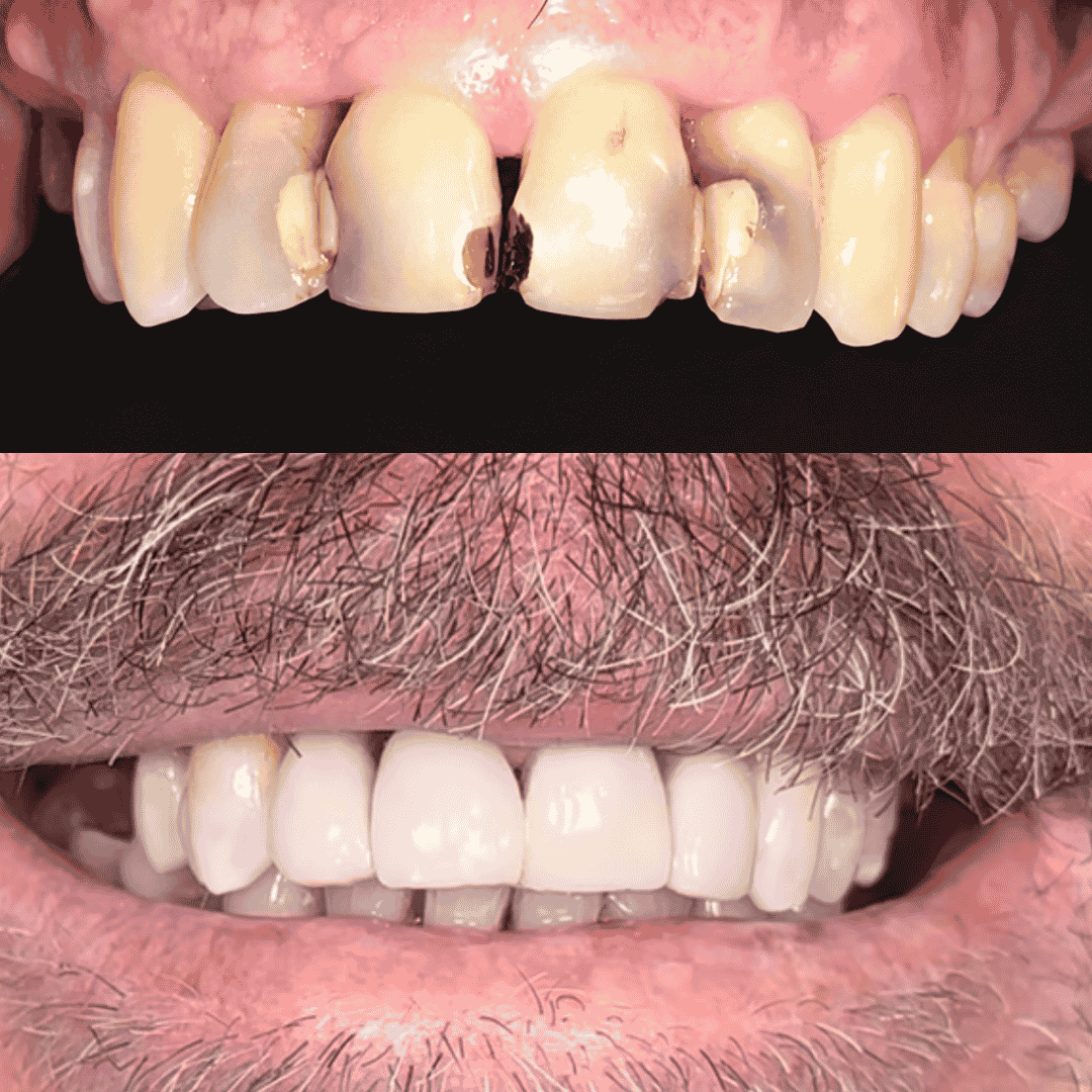 Caso real de tratamiento de caries y carillas, antes y después - Temuco