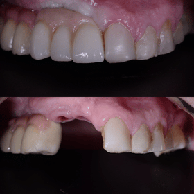 Caso real de múltiples implantes dentales, antes y después - Temuco