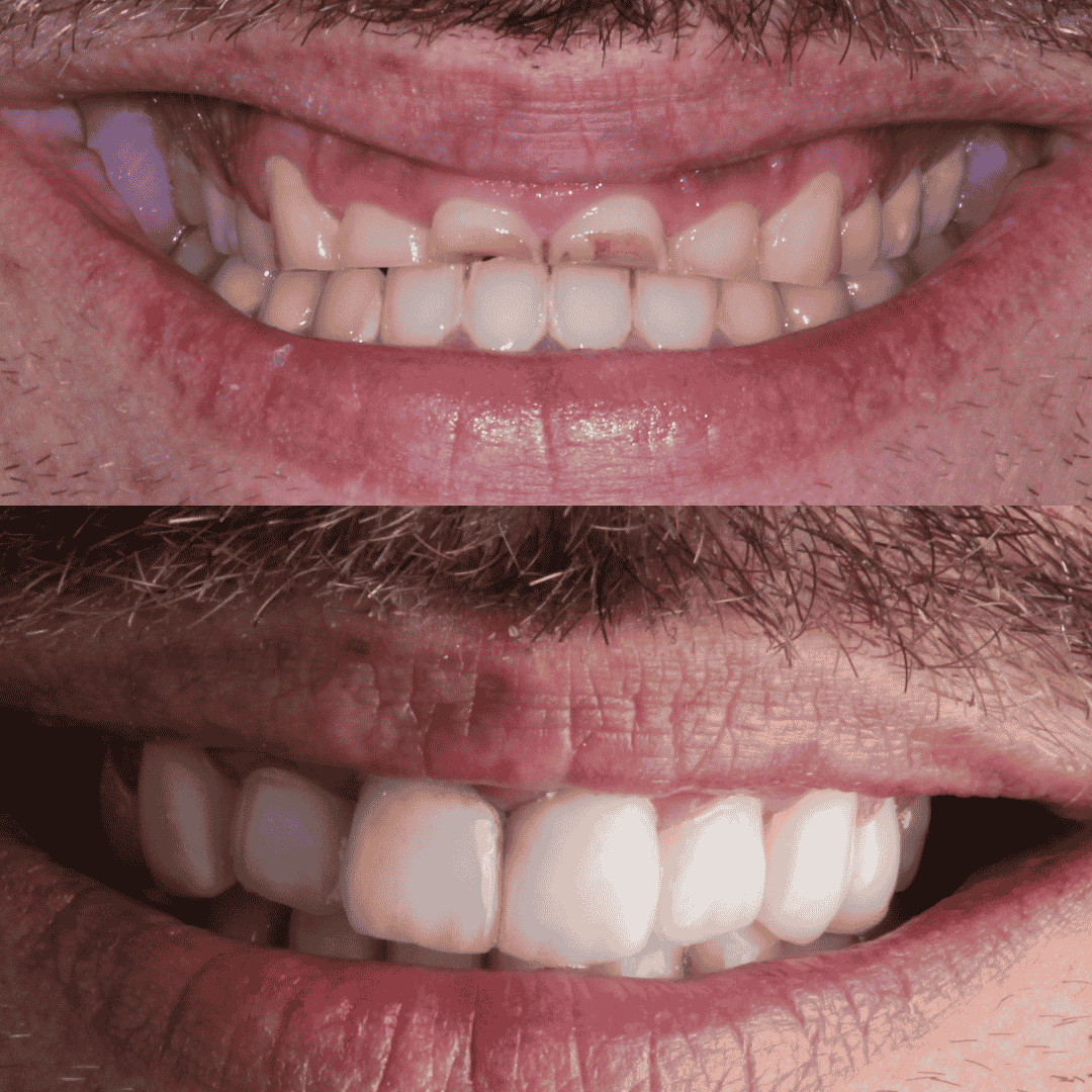 Caso real de carillas dentales para manchas y desgaste, antes y después - Temuco
