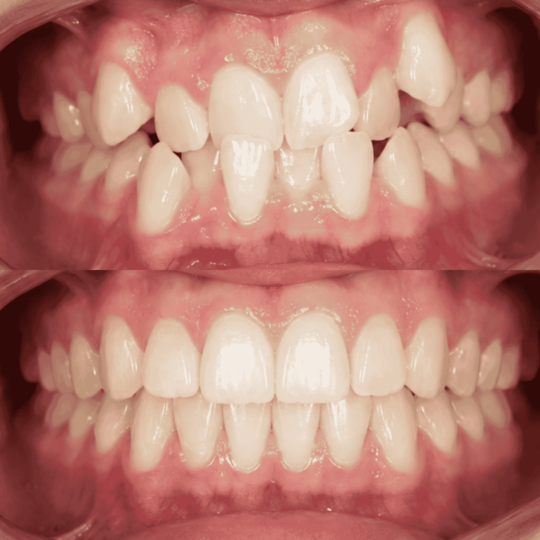 Caso real de apiñamiento con brackets metálicos, antes y después - Temuco