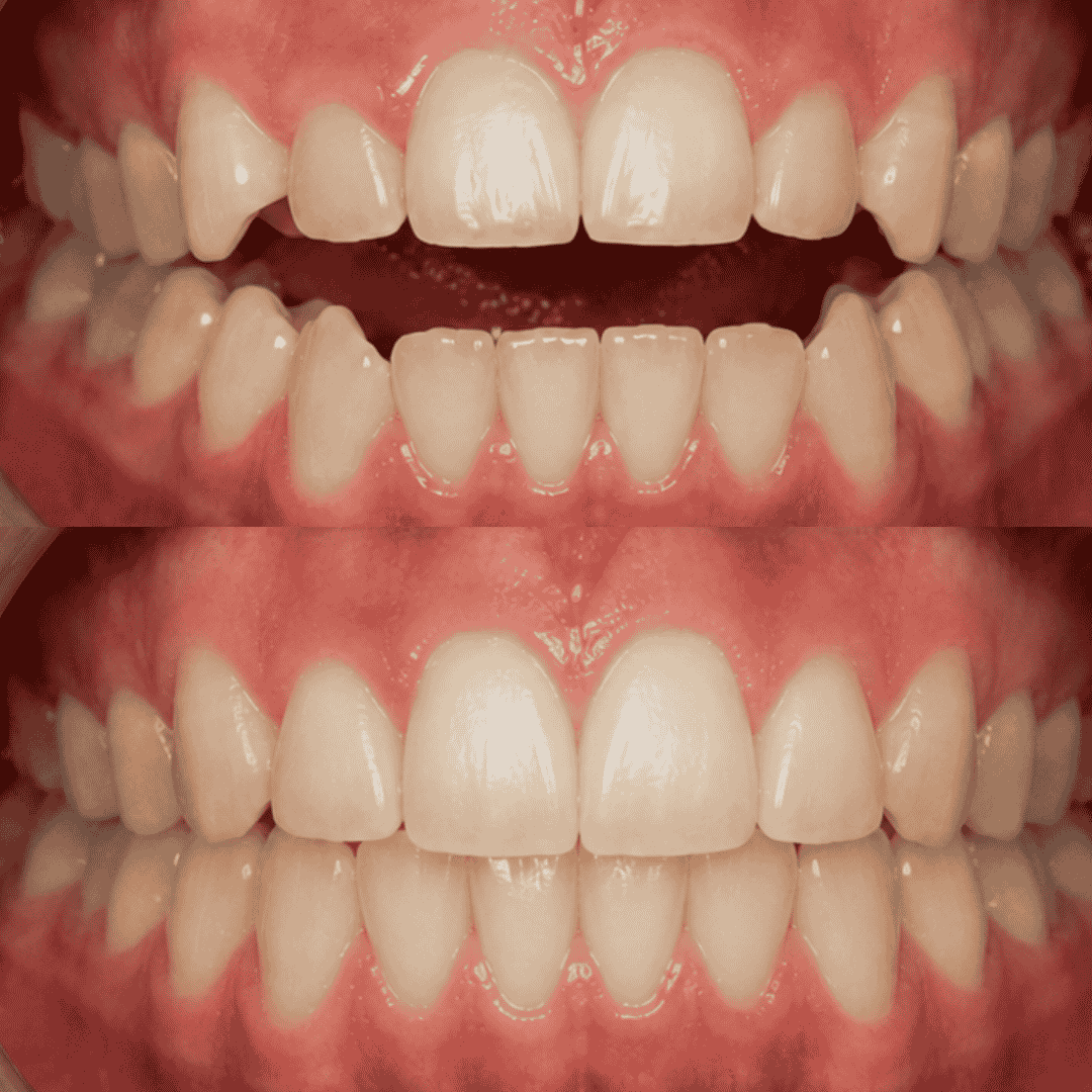 Caso real de mordida abierta con brackets estéticos, antes y después - Temuco
