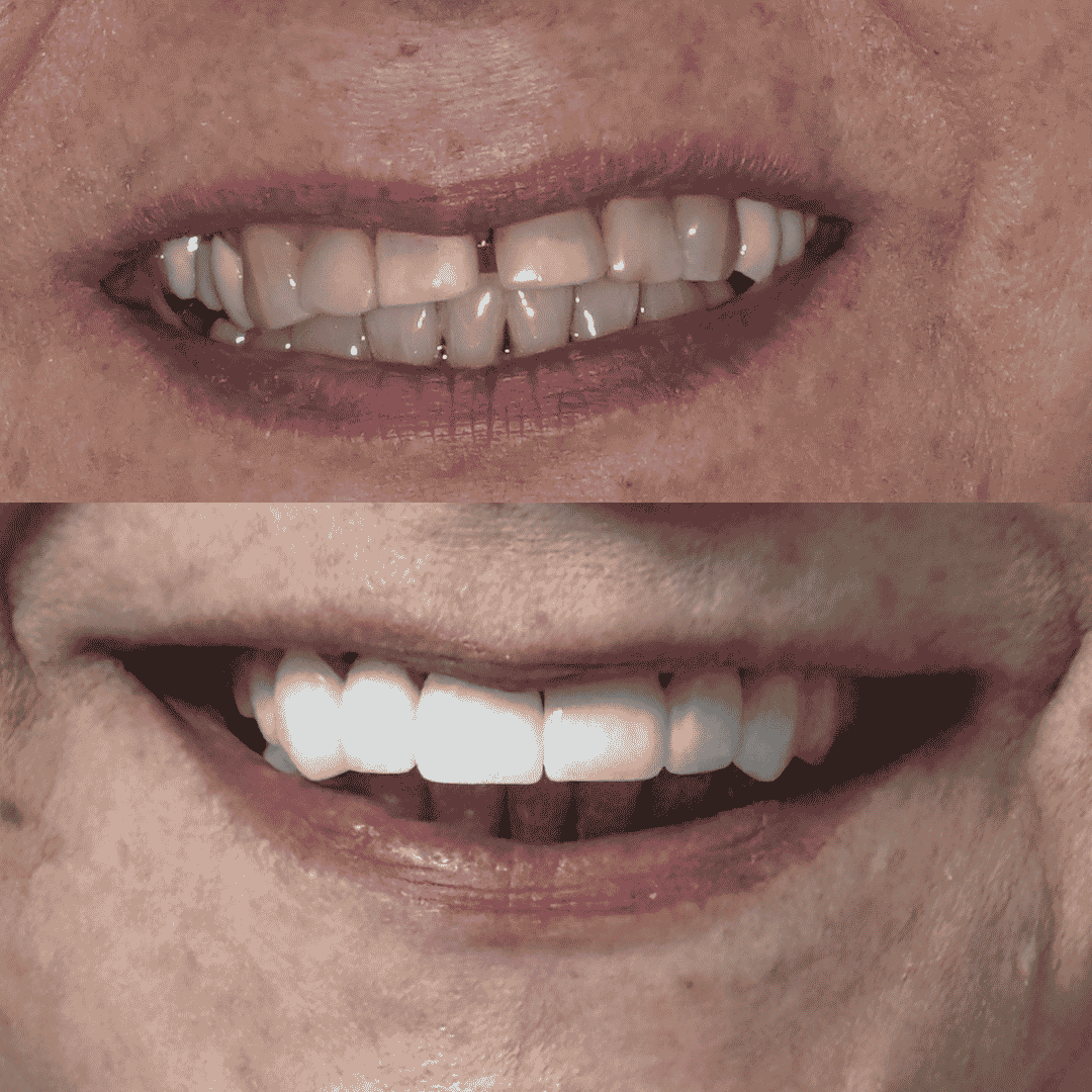Caso real de carillas de porcelana para dientes oscurecidos y desalineados, antes y después - Temuco