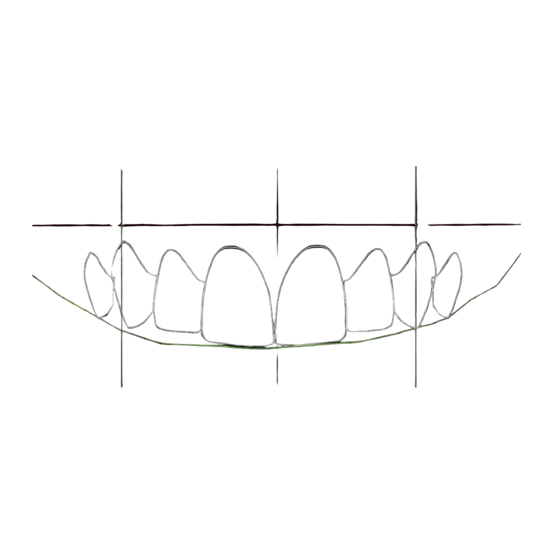 Diseño de sonrisa