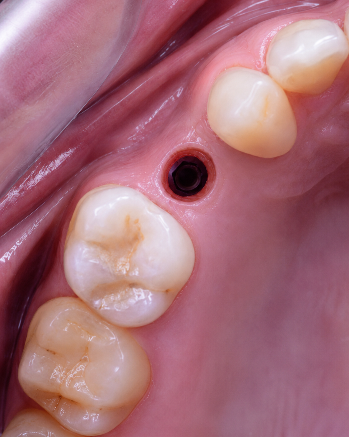 Implante de titanio colocado en el maxilar — primer paso del tratamiento de implante dental en Temuco