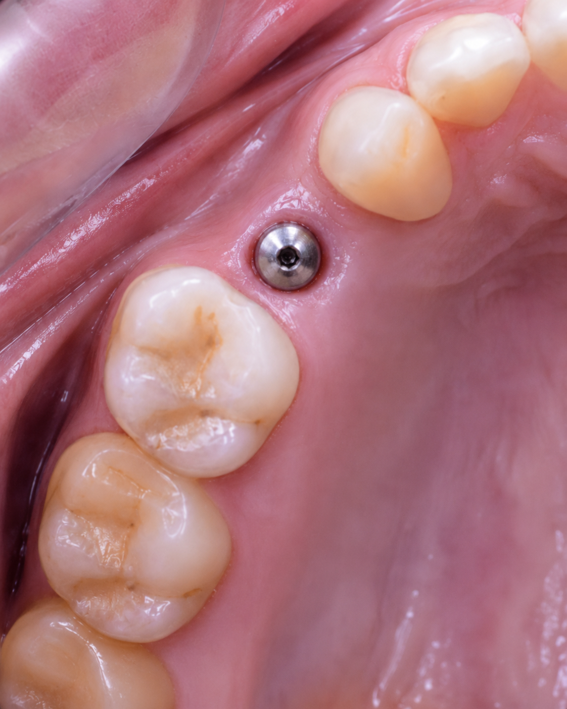 Pilar de cicatrización sobre el implante dental — fase de oseointegración en San Martin Dent Temuco