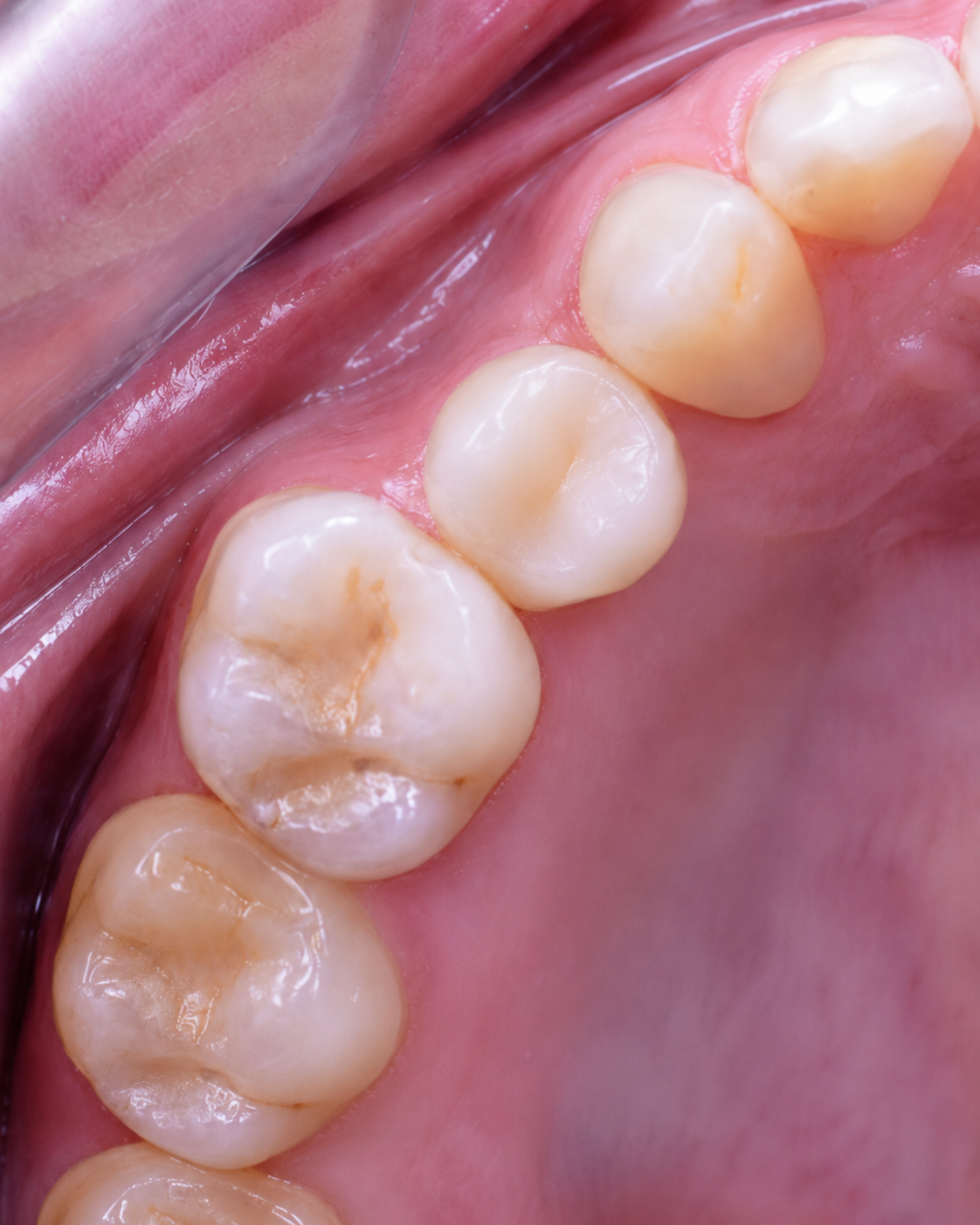 Corona definitiva instalada sobre el implante — resultado final del tratamiento de implante dental en Temuco