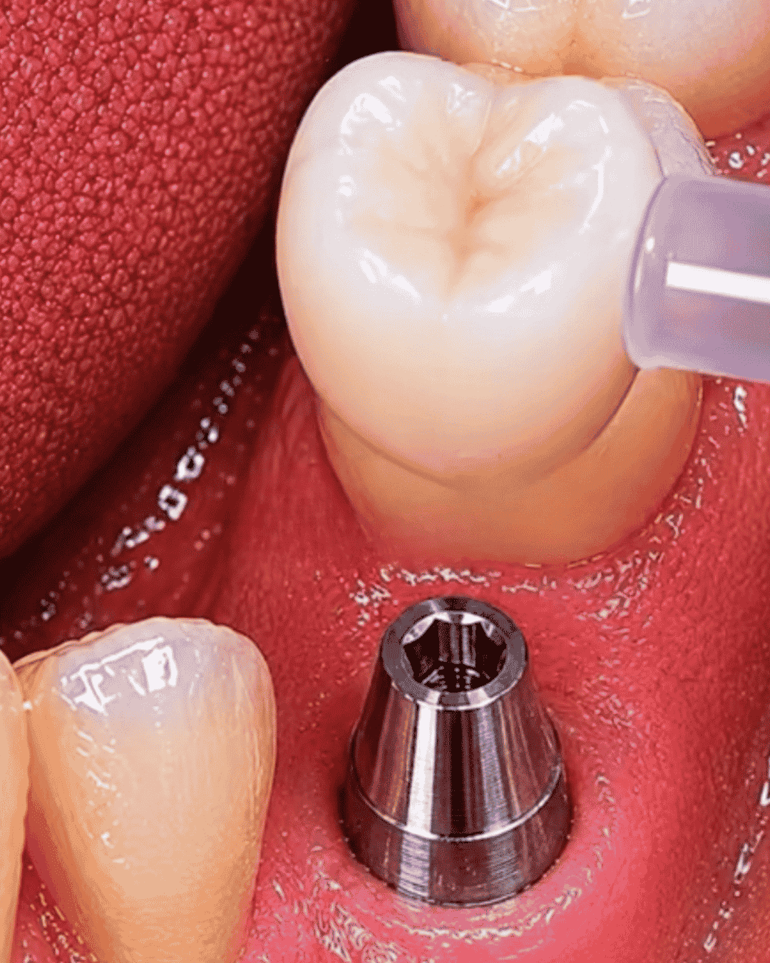 Corona definitiva de implante dental integrada naturalmente